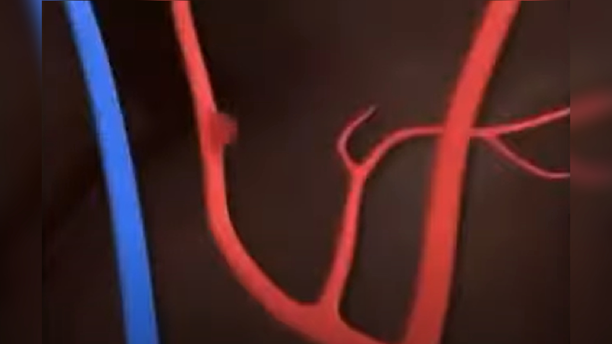 Brain Fart / Aneurysm Animation