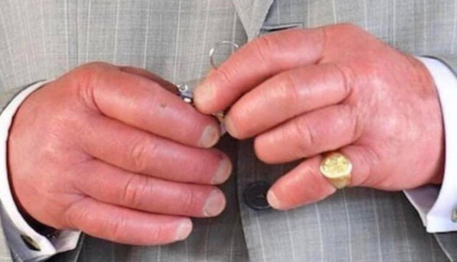 King Charles' Sausage Fingers